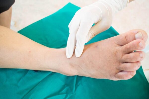 Managing Charcot Foot Nonsurgical Treatment Options Arizona Foot