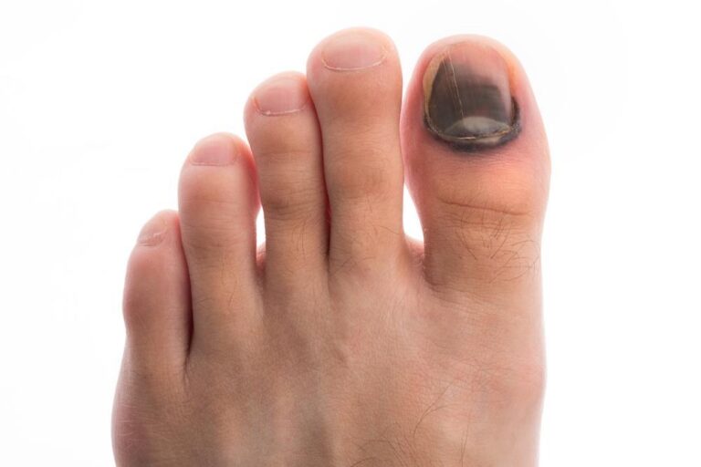 How To Get Rid Of Thick Toenails: 5 Common Mistakes (And How To Avoid Them) - 4ycxvix